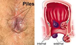 Piles Medical Diagram - Internal and External Hemorrhoids